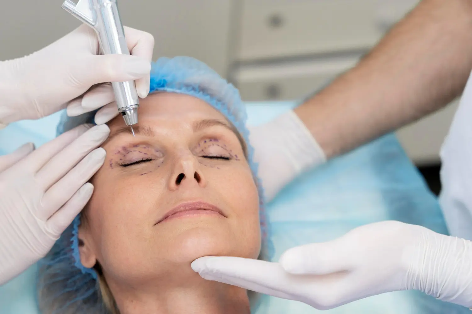 Procedimento na região das pálpebras com marcações pré-operatórias, ilustrando os benefícios da blefaroplastia