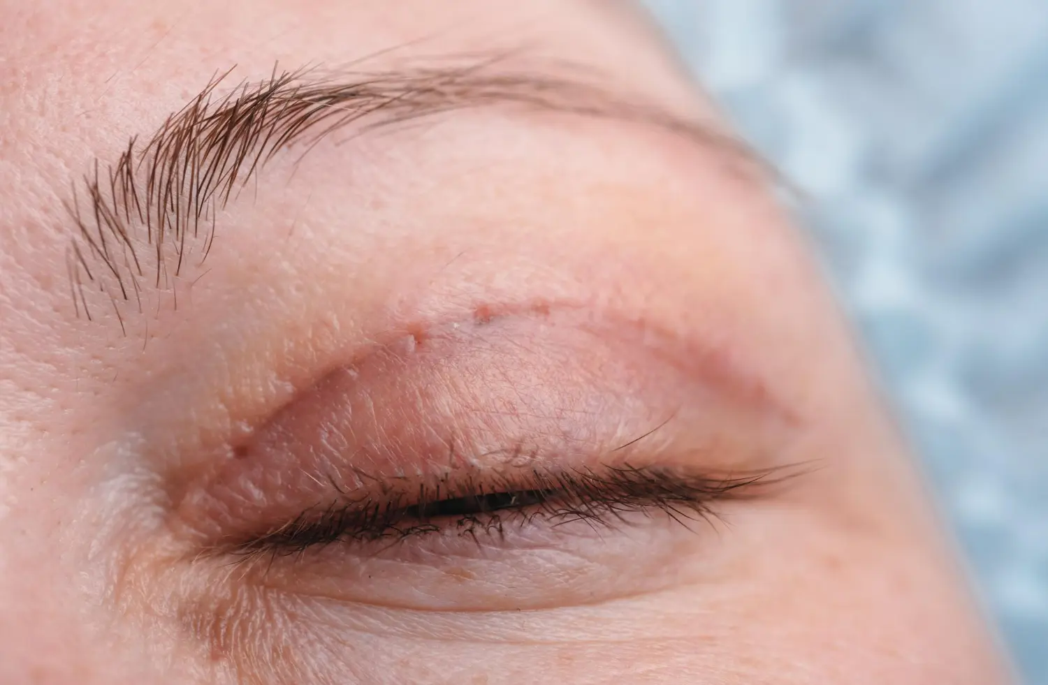 Close da pálpebra superior no pós-operatório com cicatriz discreta