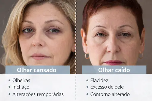 Comparativo entre olhar cansado e olhar caído com sinais de olheiras, inchaço e flacidez