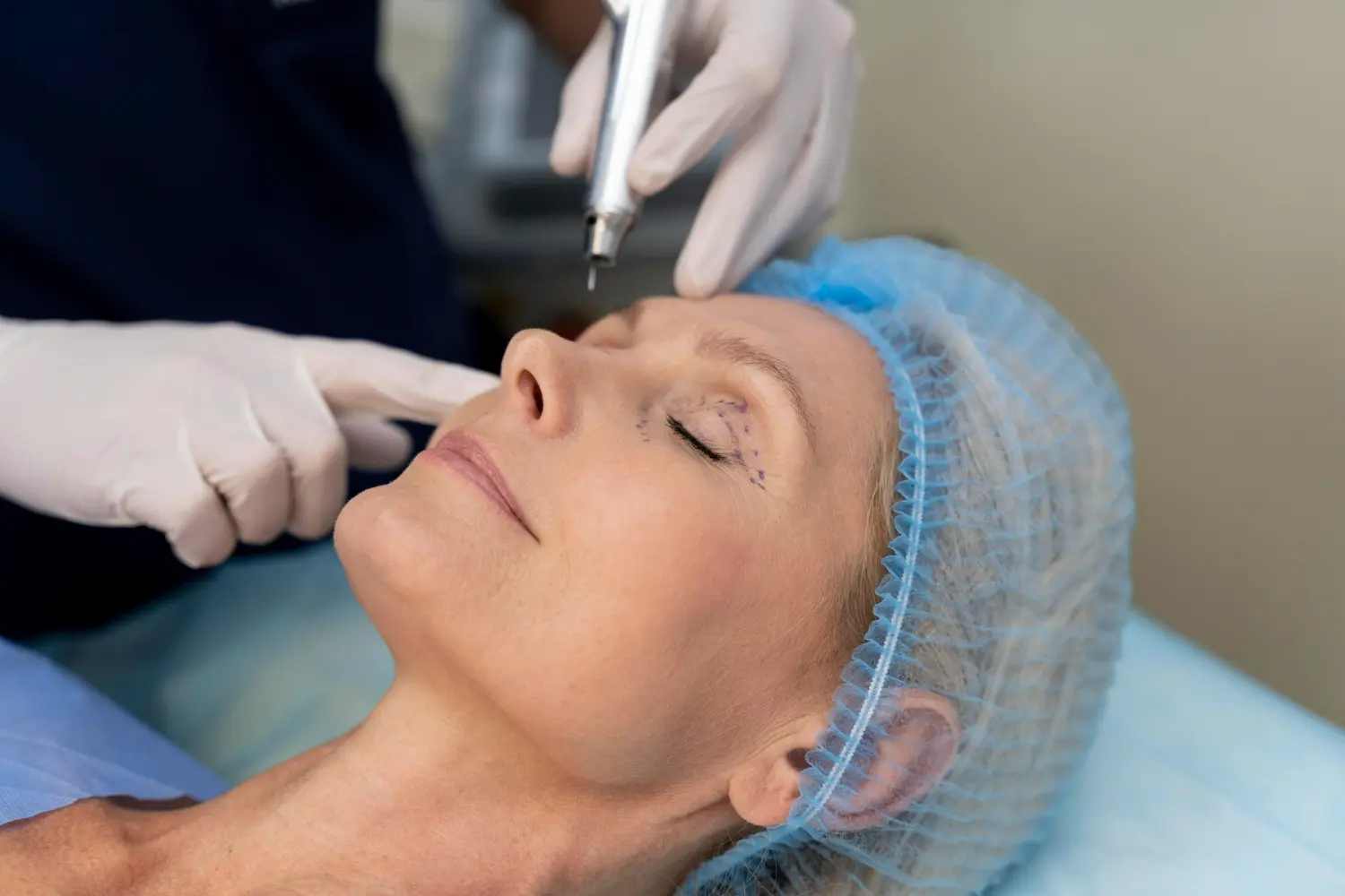 Paciente com marcações nas pálpebras durante preparação para blefaroplastia em ambiente clínico.