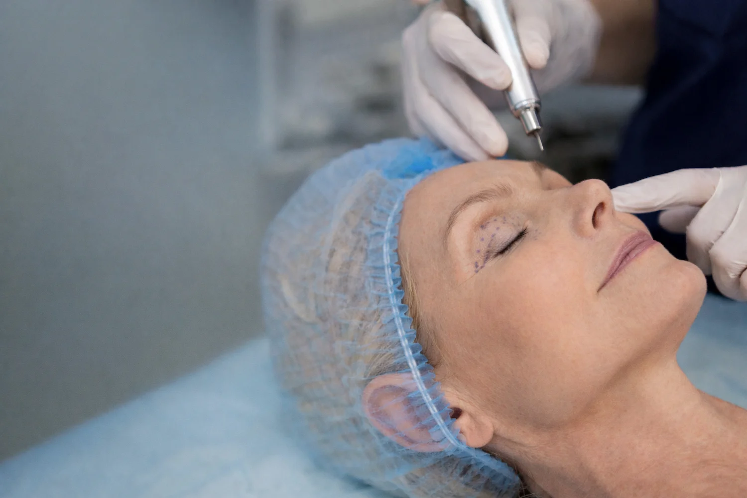 Paciente com marcações nas pálpebras ilustrando os tipos de blefaroplastia em preparo cirúrgico