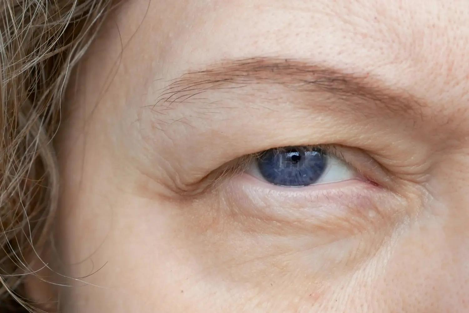Close do olho com excesso de pele na pálpebra superior, sinal de dermatocalase