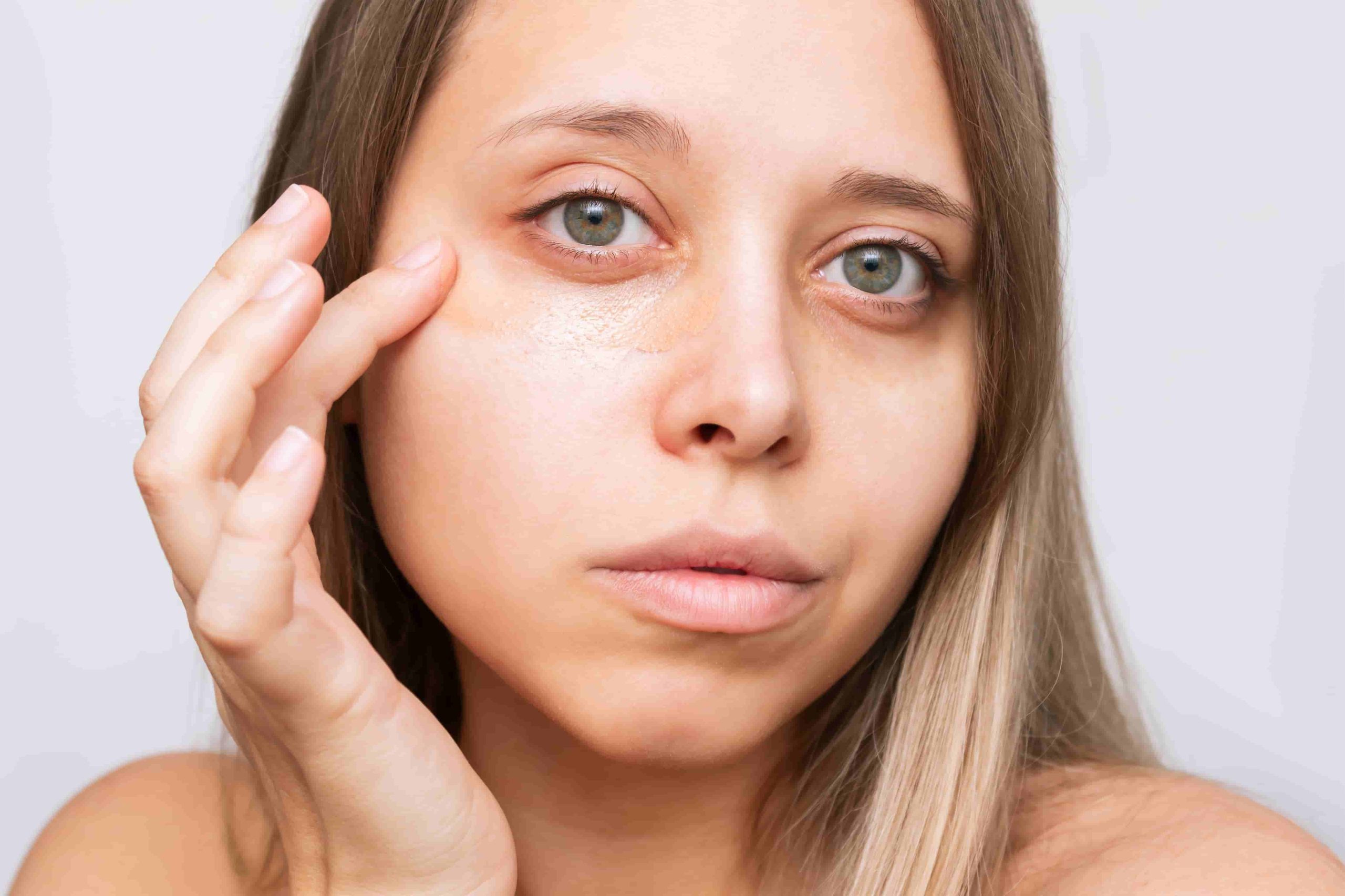 Mulher toca a região abaixo dos olhos, destacando bolsas e olheiras