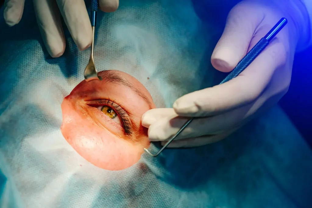 Cirurgia de pálpebras em andamento ilustra dúvida se cirurgia de pálpebras é perigosa